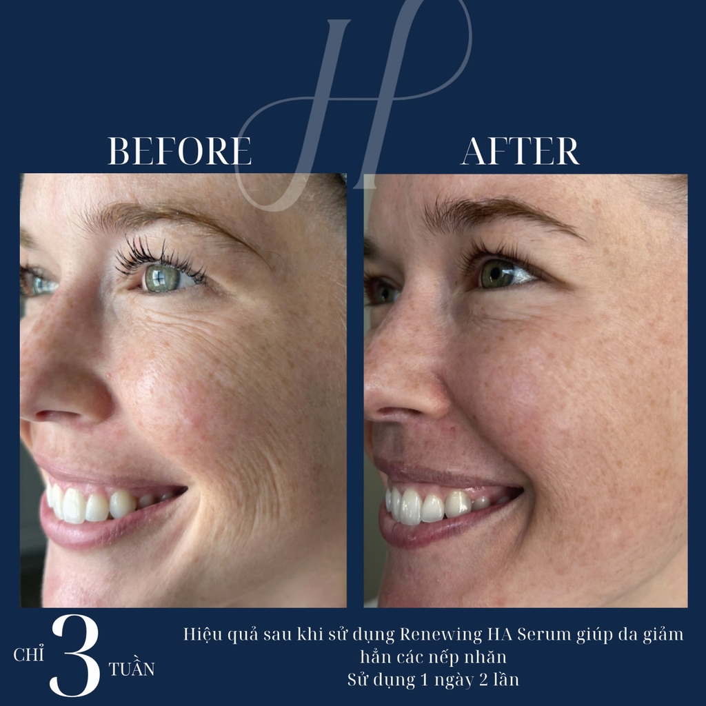 HYDRINITY Renewing HA Serum: Bí Quyết Trẻ Hóa Da Tức Thì Với HA "Siêu Tăng Áp"