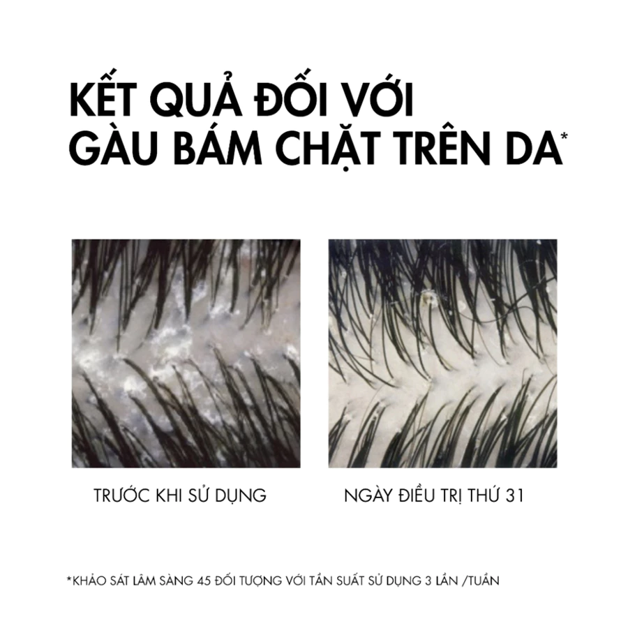 Dầu gội Vichy giảm gàu cho da đầu nhạy cảm 200ml