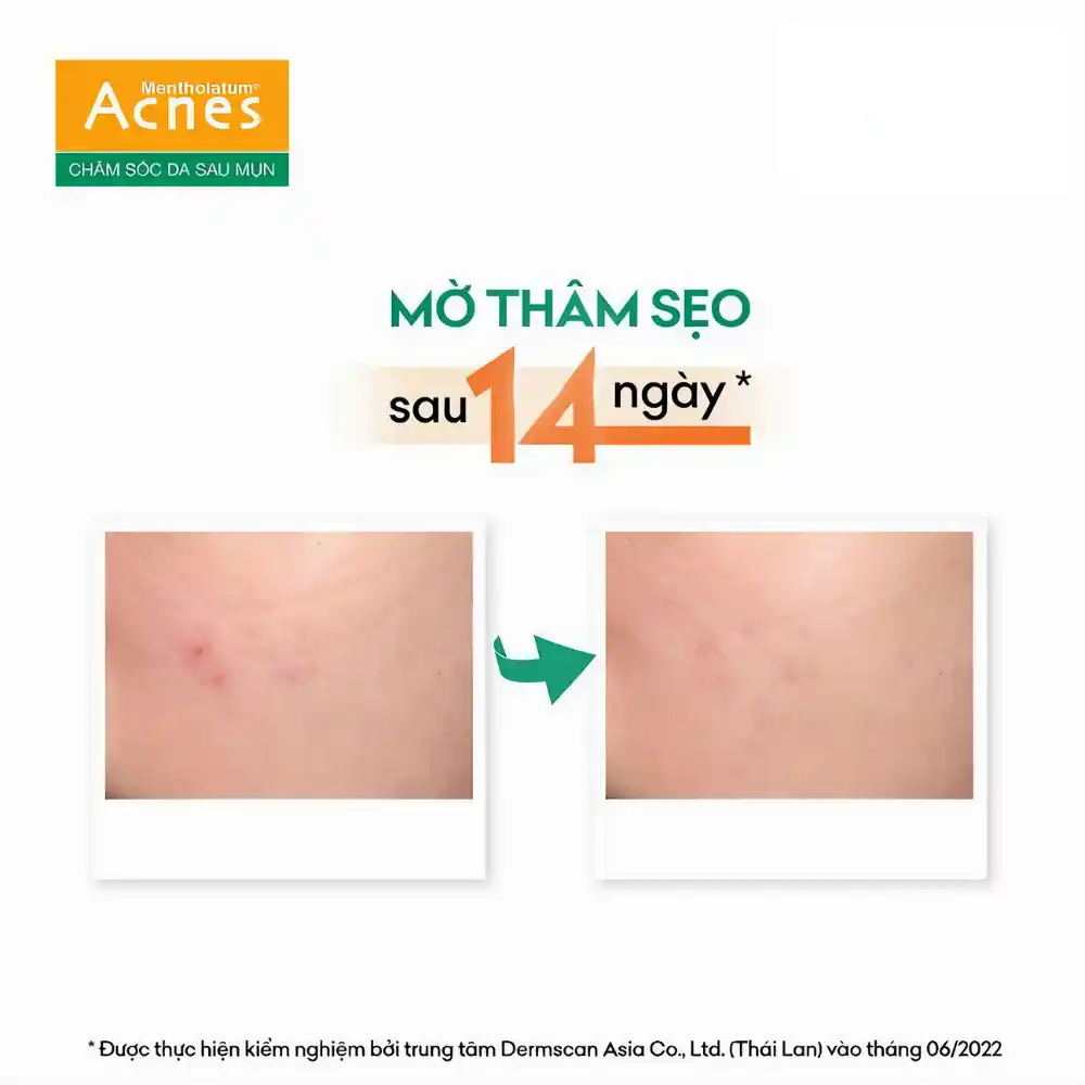 Gel dưỡng Acnes giúp mờ sẹo & giảm thâm mụn 12g.