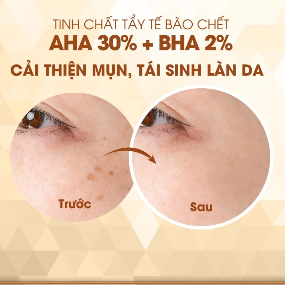 Tinh chất tẩy tế bào chết Care:Nel AHA BHA làm sạch da, cân bằng độ PH, giảm mụn đầu đen 30ml