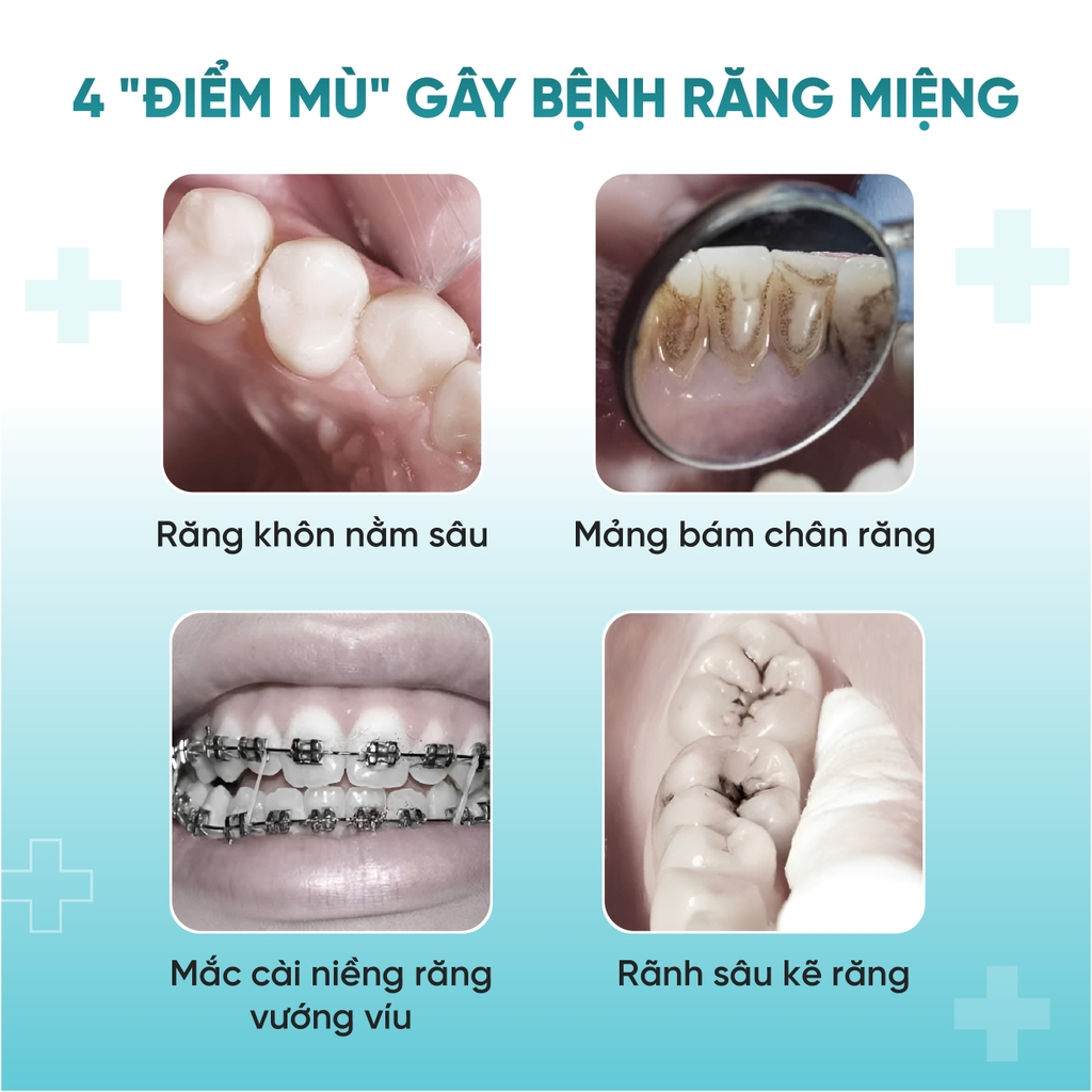 Bàn Chải Đánh Răng Chuyên Dụng Cho Người Niềng Răng Daily Smile Sợi PBT Đức Cao Cấp