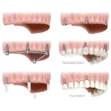 Implant-Nha Khoa