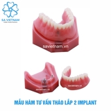 Hàm tư vấn tháo lắp 2 implant