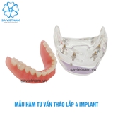 Hàm tư vấn tháo lắp 4 implant