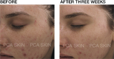 Serum làm dịu da PCA Skin anti-redness 29.5ml