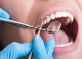 Lấy cao răng định kỳ , tẩy trắng răng laser