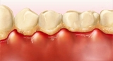 Điều trị viêm lợi, viêm quanh răng