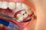 Hàn răng sâu vỡ, hàn cổ răng ê buốt