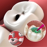 Điều trị tủy ,đo chiều dài ống tủy bằng máy