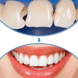 Hàn răng sâu vỡ, hàn cổ răng ê buốt