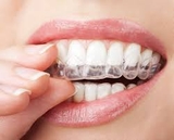 Tiền chỉnh nha từ 5 đến 10 tuổi