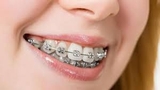Tiền chỉnh nha từ 5 đến 10 tuổi
