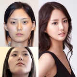 Nâng mũi Model