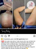 Kem trị rạn da StectHeal cho mẹ bầu