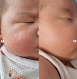 KEM DƯỠNG MLE ATOPALM 100ML