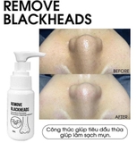 Ủ MỤN ĐẦU ĐEN REMOVE BLACKHEADS 50ML FULLBOX