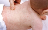 Hiểu rõ triệu chứng sốt siêu vi ở trẻ em để chăm sóc con đúng cách