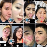 Serum Lumos Acne Chuyên Cho Da Mụn