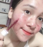 Serum So'Natural Làm Giảm Mụn, Tái Tạo Làn Da 35ml Red Peel Tingle Serum
