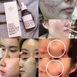 Serum So'Natural Làm Giảm Mụn, Tái Tạo Làn Da 35ml Red Peel Tingle Serum