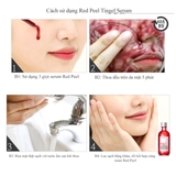 Serum So'Natural Làm Giảm Mụn, Tái Tạo Làn Da 35ml Red Peel Tingle Serum
