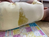Bỉm Bị Tràn Về Bờ Mông/Lưng Đêm: 5 Nguyên Nhân Mẹ Thường Bỏ Qua
