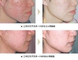 KEM TRỊ MỤN DALACIN T GEL 1% - Japan