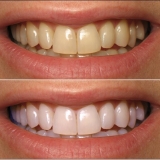 Bột Đánh Răng Tẩy Trắng Eucryl Toothpowder 50g