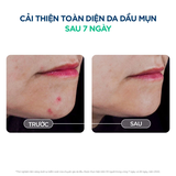 Serum Bioderma Sébium Serum Sáng Mịn, Mờ Thâm Cho Da Dầu Mụn 30ml
