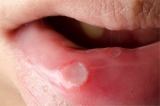 Bị Nhiệt Miệng Sau Quan Hệ Bằng Miệng Phải Làm Sao? Cách Chăm Sóc Và Phòng Ngừa