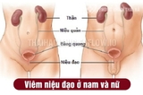 Dấu Hiệu Viêm Niệu Đạo Và Cách Phòng Ngừa Hiệu Quả