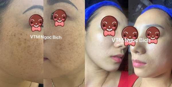 Kết Quả Điều Trị Nám Tại Ngọc Bích