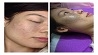 Nhận diện nám và cách điều trị