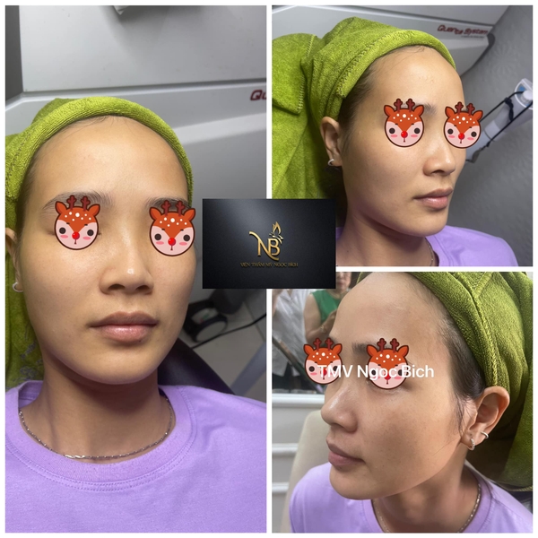 Kết Quả Trị Tàn Nhang Tại Ngọc Bích