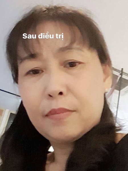 Khách Hàng Điều Trị Nám Thành Công