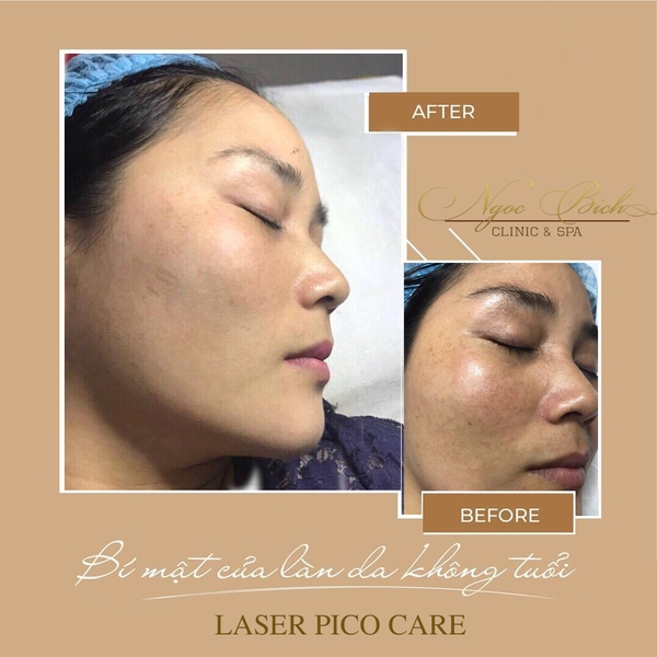 Kết Qủa trị nám tại Ngọc Bích