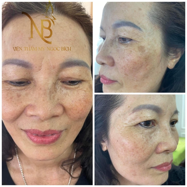 ĐIỀU TRỊ THÀNH CÔNG HÀNG TRĂM CA NÁM KHÓ