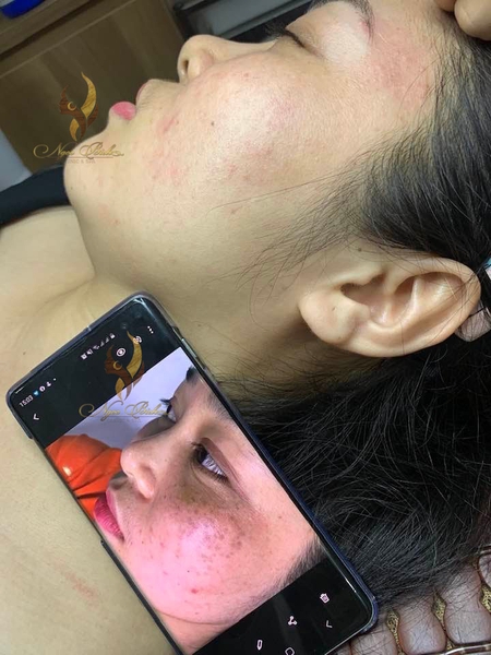 Kết quả điều trị nám tại Ngọc Bích