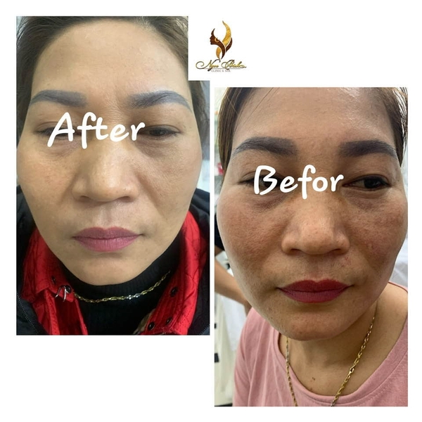 THÊM 1 CA TRỊ NÁM CỰC ĐỈNH ĐẾN TỪ NGỌC BÍCH