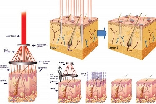 TẠI SAO NÊN LỰA CHỌN ĐIỀU TRỊ SẸO MỤN BẰNG LASER FRACTIONAL CO2 ?
