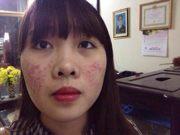 Da nhiễm hoá chất