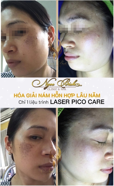 HÓA GIẢI NÁM LÂU NĂM BẰNG LASER PICO CARE