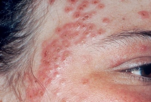 Eczema (chàm)