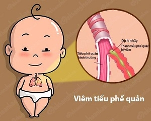 Viêm tiểu phế quản có cần dùng kháng sinh