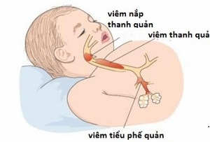 Bệnh viêm tiểu phế quản ở trẻ em