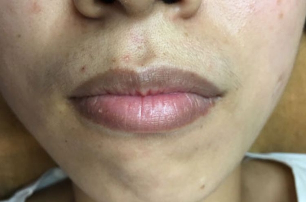 Môi thâm do hút thuốc cà phê có thể khử được không? 2 Các Phương Pháp Khử Thâm Môi Cho Nam? Phun Khử Thâm Môi Nam Natalie.vn