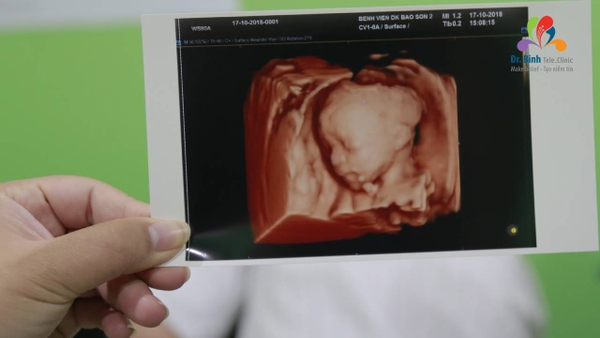 Siêu âm 4D thai 22 tuần: Thời điểm vàng phát hiện dị tật bẩm sinh