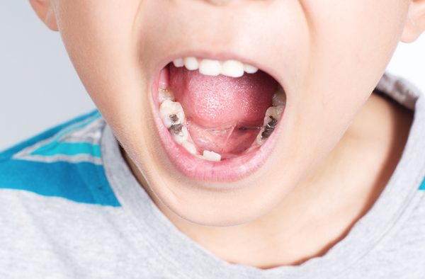 Sâu răng ở trẻ em: Hãy nhận biết và điều trị lúc mới chớm