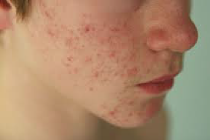 CÁCH ĐƠN GIẢN GIÚP TỰ CHĂM SÓC VÀ KIỂM SOÁT MỤN TRỨNG CÁ