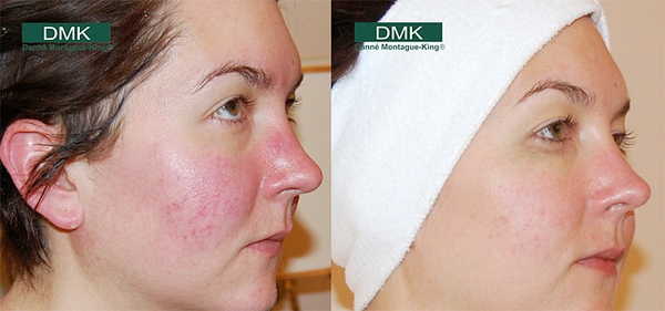 Direct delivery vitamin C serum xua tan nỗi lo về nám 